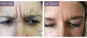 Patient 2: before and after Botox treatment.